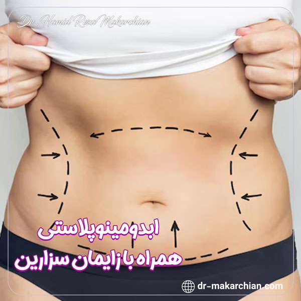 ابدومینوپلاستی همراه با زایمان سزارین - دکتر حمیدرضا مکارچیان