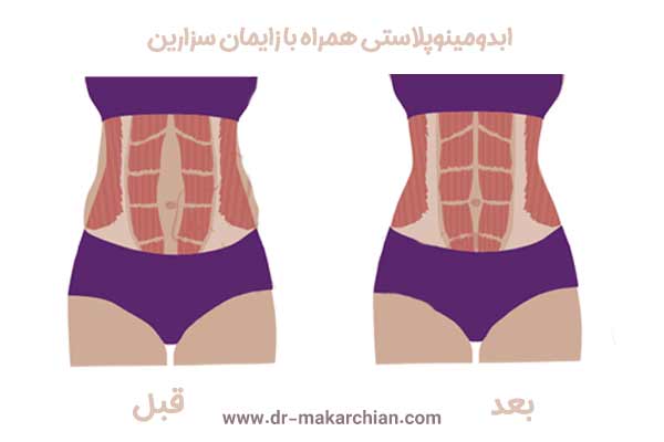  ابدومینوپلاستی همراه با زایمان سزارین - دکتر حمیدرضا مکارچیان