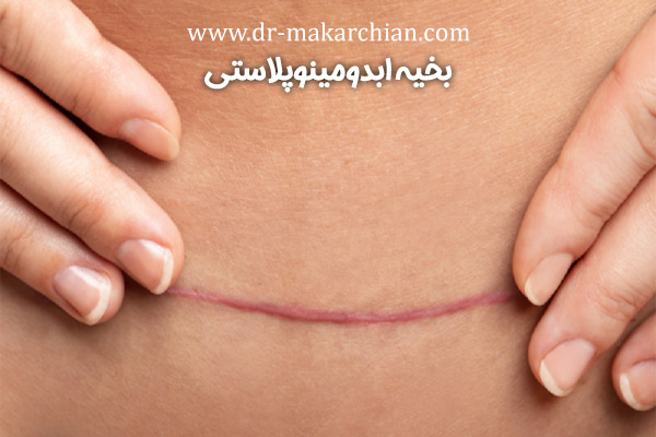 بخیه ابدومینوپلاستی + دکتر حمیدرضا مکارچیان
