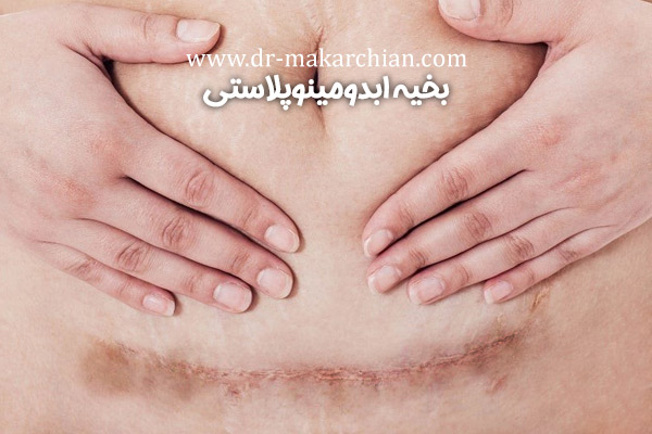 بخیه ابدومینوپلاستی+ دکتر حمیدرضا مکارچیان