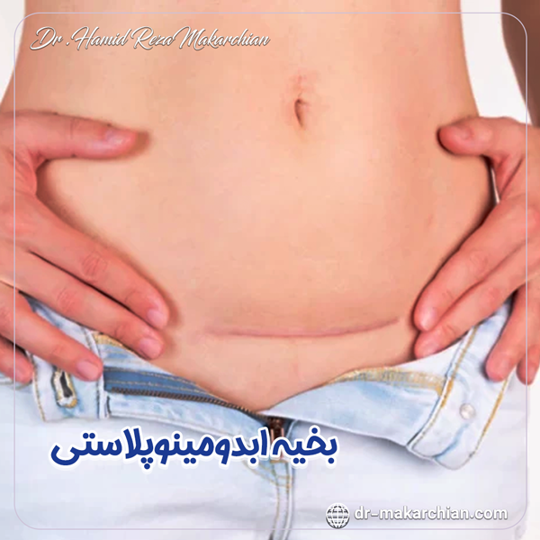 بخیه ابدومینوپلاستی - دکتر حمیدرضا مکارچیان