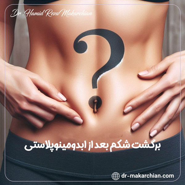 برگشت شکم بعد از عمل ابدومینوپلاستی + دکتر حمیدرضا مکارچیان