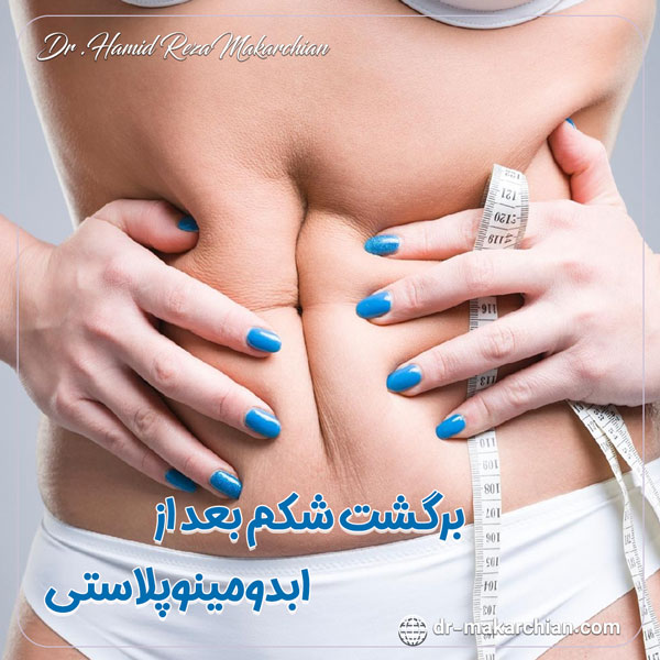 برگشت شکم بعد از ابدومینوپلاستی - دکتر حمیدرضا مکارچیان