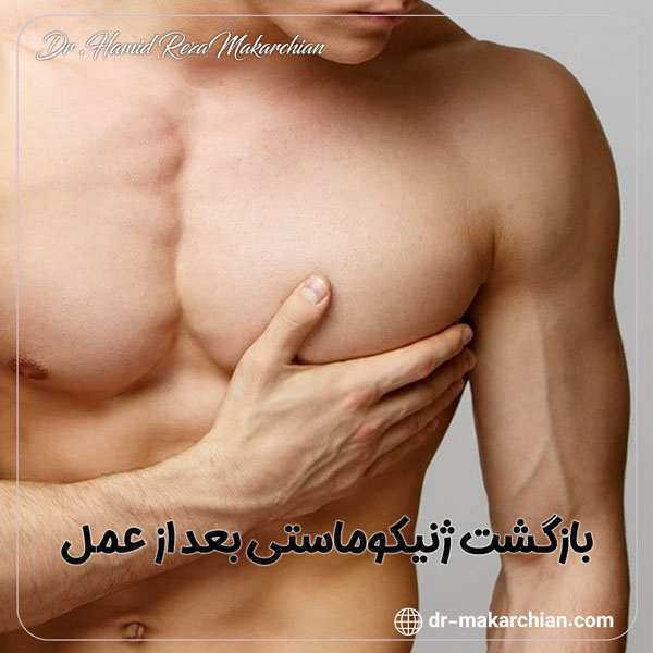 بازگشت ژنیکوماستی بعد از عمل - دکتر حمیدرضا مکارچیان