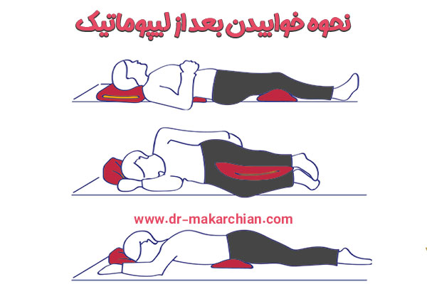 نحوه خوابیدن بعد از لیپوماتیک - دکتر حمیدرضا مکارچیان