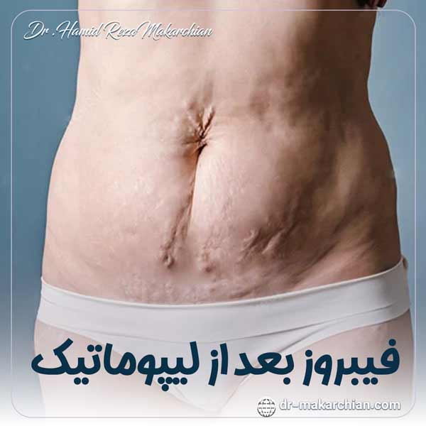 فیبروز بعد از لیپوماتیک - دکتر حمیدرضا مکارچیان