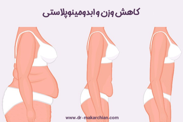 ابدومینوپلاستی - دکتر حمیدرضا مکارچیان