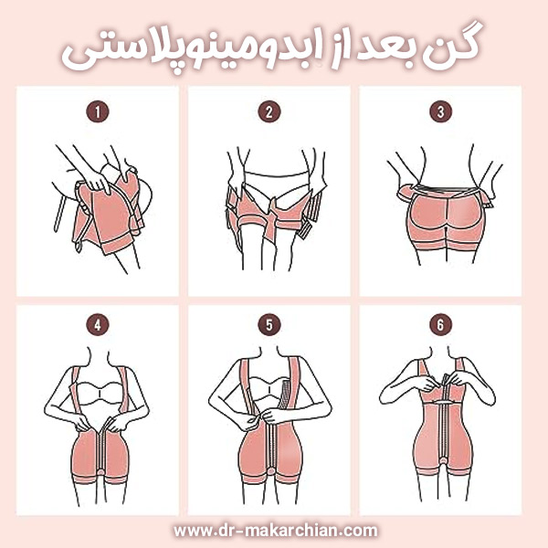گن بعد از ابدومینوپلاستی + دکتر حمیدرضا مکارچیان