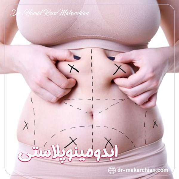 ابدومینوپلاستی + دکتر حمیدرضا مکارچیان