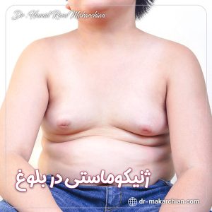 ژنیکوماستی در بلوغ - دکتر حمیدرضا مکارچیان
