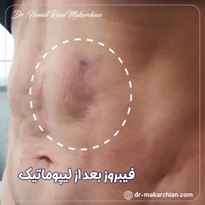 فیبروز بعد از لیپوماتیک + دکتر حمیدرضا مکارچیان