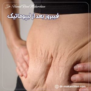 فیبروز بعد از لیپوماتیک + دکتر حمیدرضا مکارچیان