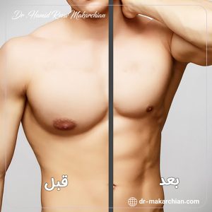 ژنیکوماستی در بدنسازی + دکتر حمیدرضا مکارچیان