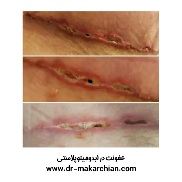 عوارض ابدومینوپلاستی + دکتر حمیدرضا مکارچیان