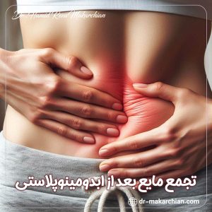 تجمع مایع بعد از ابدومینوپلاستی + دکتر حمیدرضا مکارچیان