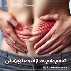 تجمع مایع بعد از ابدومینوپلاستی + دکتر حمیدرضا مکارچیان