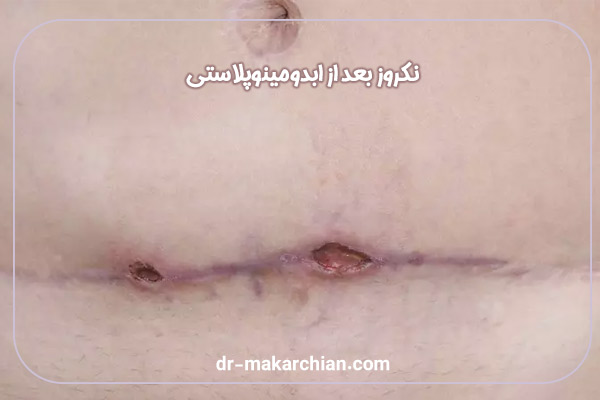 نکروز بعد از ابدومینوپلاستی + دکتر حمیدرضا مکارچیان