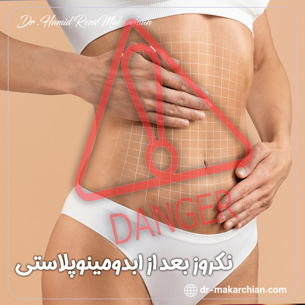 نکروز بعد از ابدومینوپلاستی + دکتر حمیدرضا مکارچیان