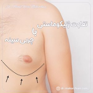 تفاوت ژنیکوماستی با چربی سینه + دکتر حمیدرضا مکارچیان