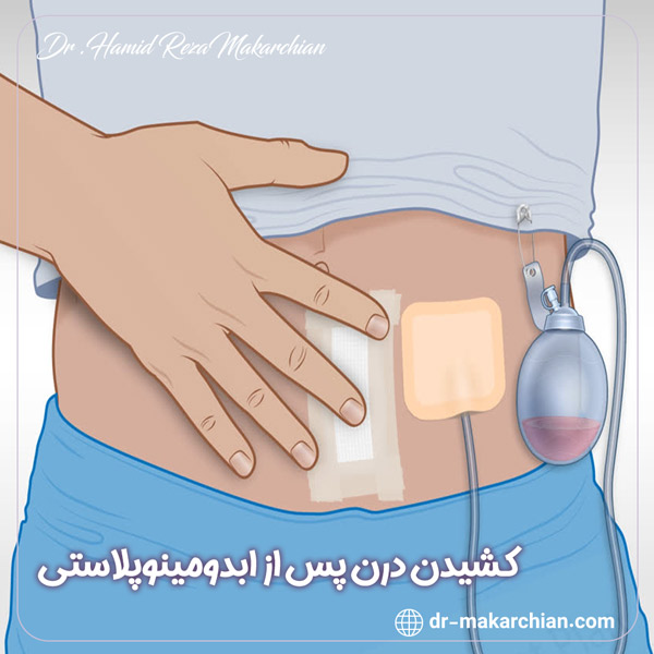 کشیدن درن پس از ابدومینوپلاستی + دکتر حمیدرضا مکارچیان