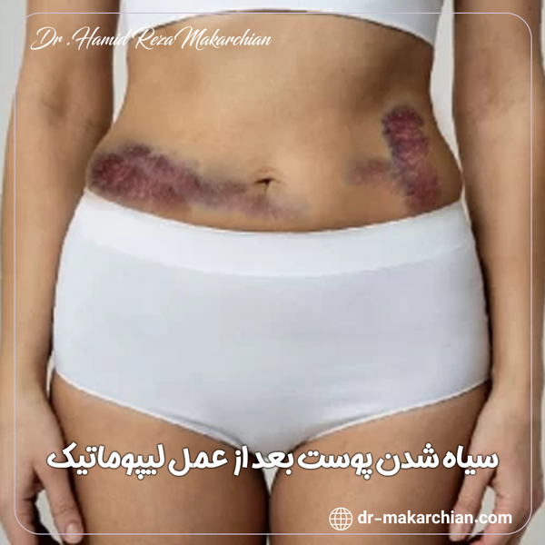 سیاه شدن پوست بعد از عمل لیپوماتیک + دکتر حمیدرضا مکارچیان
