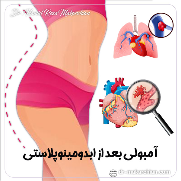آمبولی بعد از ابدومینوپلاستی + دکتر داریوش محمدی