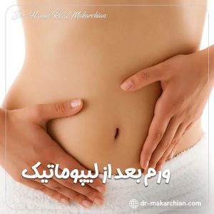 ورم بعد از لیپوماتیک + دکتر حمیدرضا مکارچیان