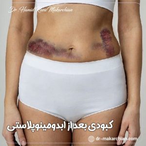 کبودی بعد از ابدومینوپلاستی + دکتر حمیدرضا مکارچیان
