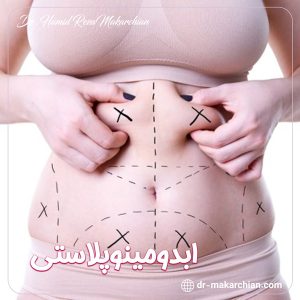 ابدومینوپلاستی + دکتر حمیدرضا مکارچیان