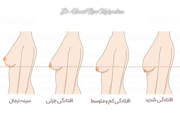 لیفت سینه در تهران - دکتر حمیدرضا مکارچیان