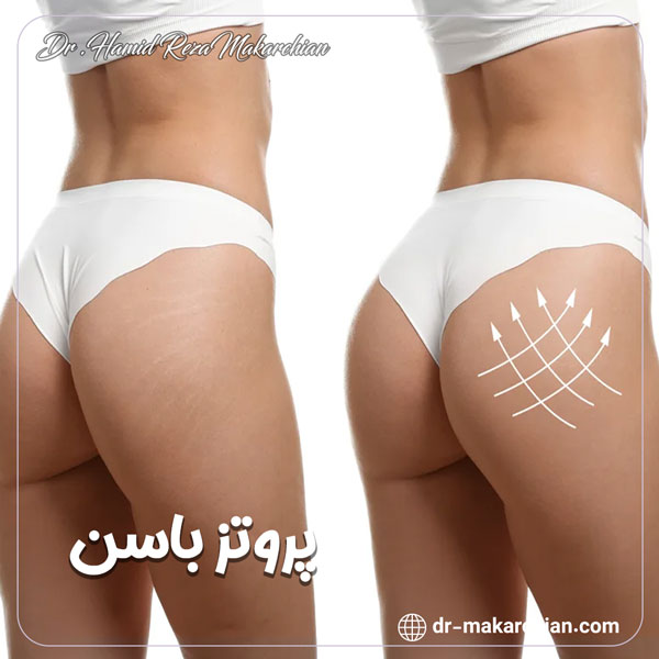 جراحی پروتز باسن + دکتر حمیدرضا مکارچیان