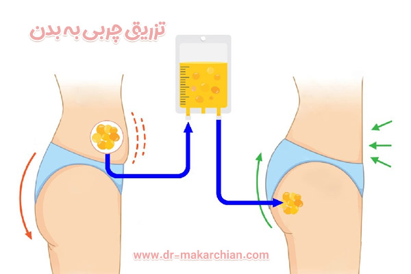 تزریق چربی به بدن + دکتر حمیدرضا مکارچیان