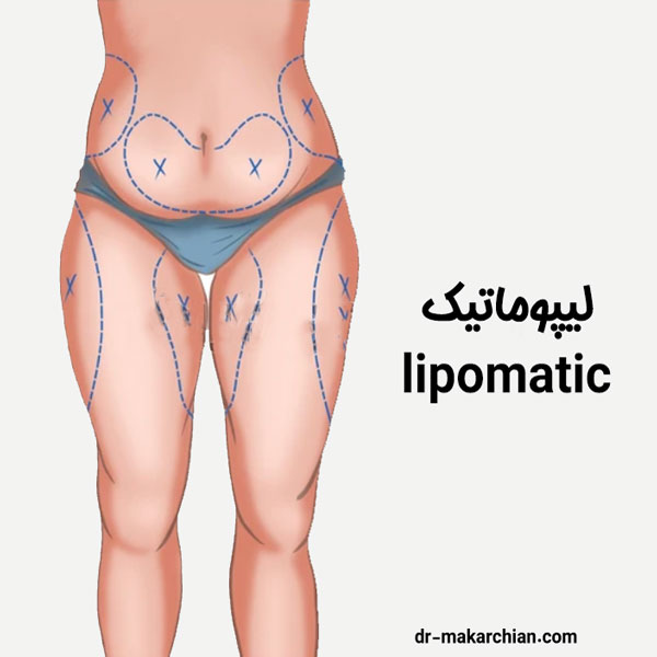 لیپوماتیک در تهران - دکتر حمیدرضا مکارچیان
