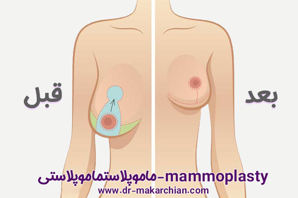 ماموپلاستی در تهران - دکتر حمیدرضا مکارچیان
