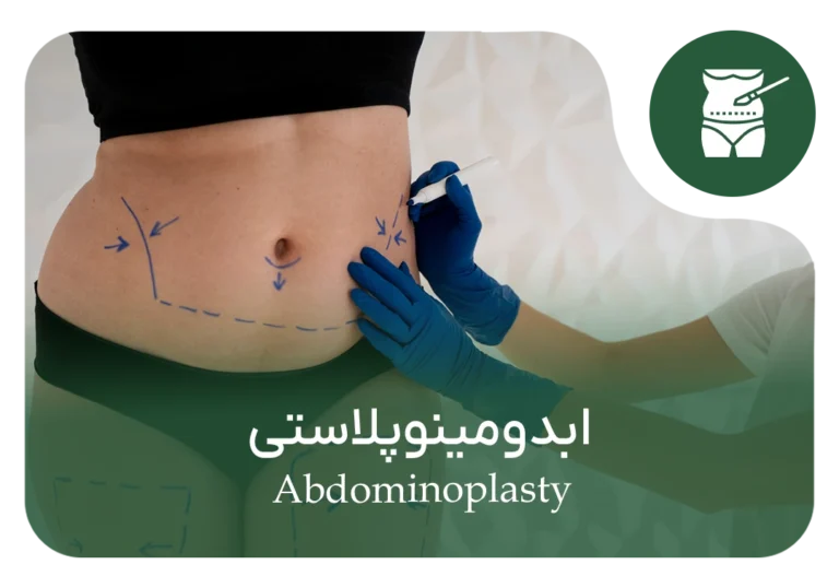 ابدومینوپلاستی