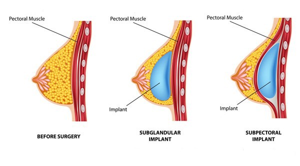 قبل و بعد از عمل پروتز سینه