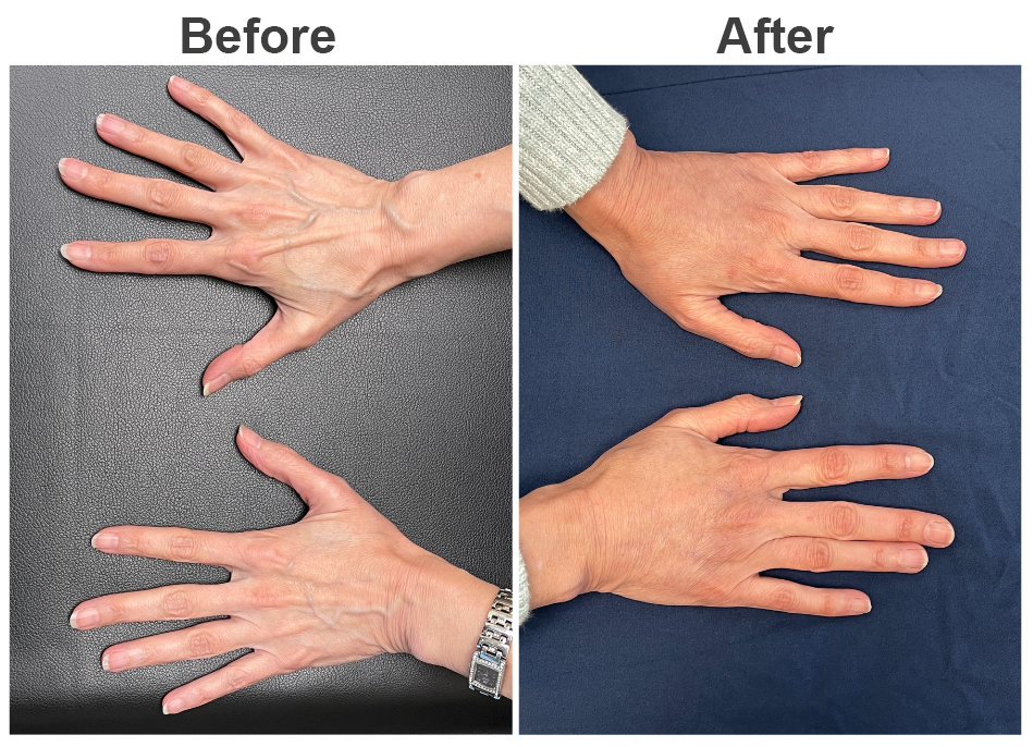 قبل و بعد از تزریق چربی به دست