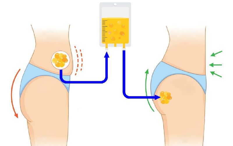 فرآیند گام به گام تزریق چربی به باسن