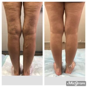 قبل و بعد از لیپوساکشن ران