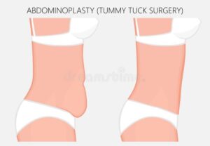 قبل و بعد عمل ابدومینوپلاستی