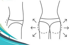 تغییر فرم باسن با ترنسفر باسن