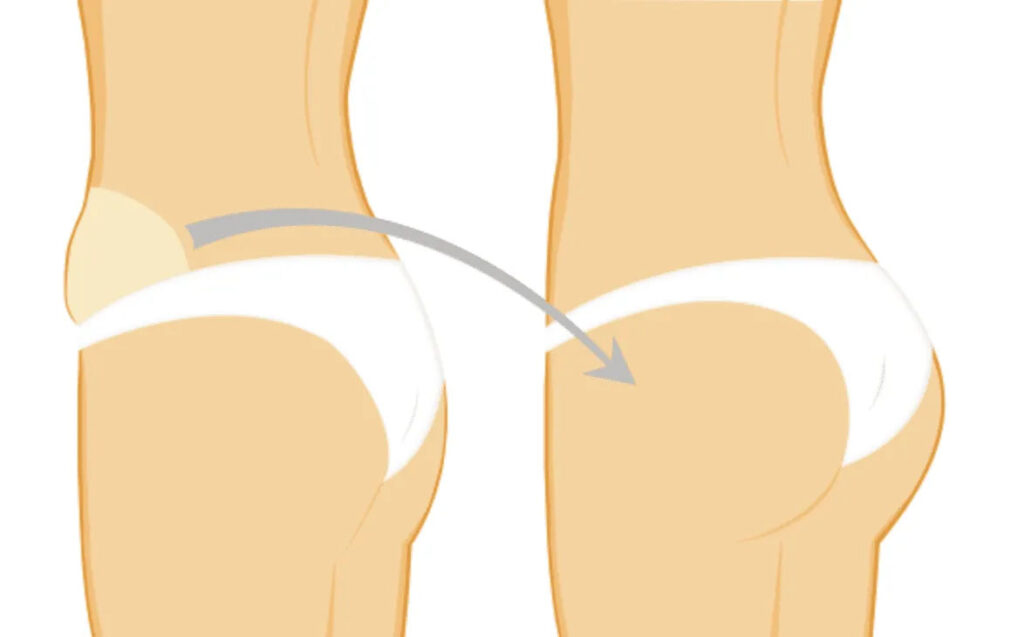 ترنسفر باسن: راز دستیابی به باسنی برجسته و طبیعی با چربی بدن خودتان