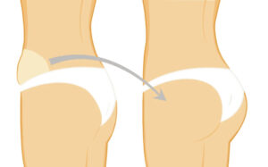 ترنسفر باسن: راز دستیابی به باسنی برجسته و طبیعی با چربی بدن خودتان