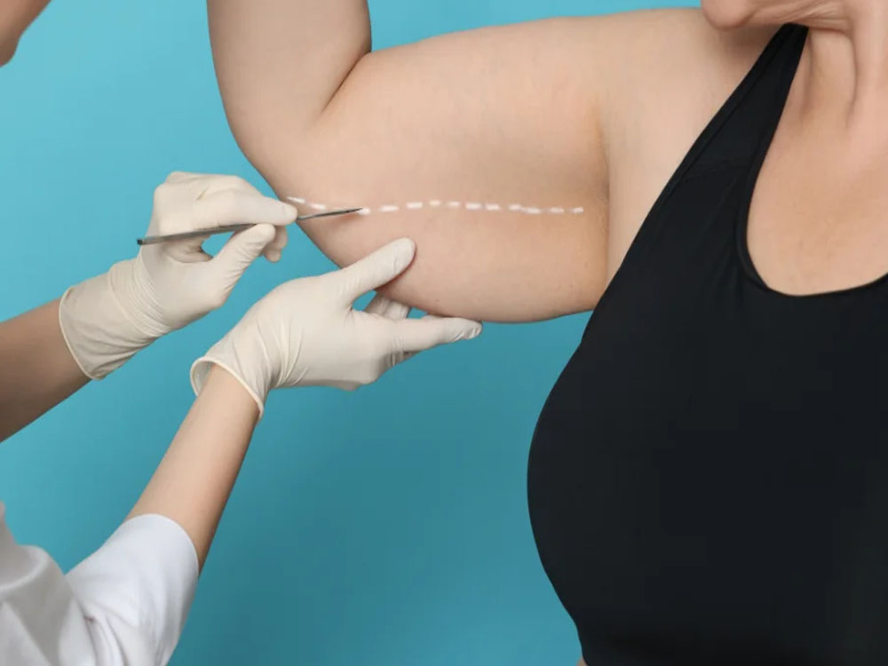 لیپو بازو: خداحافظی با بازوهای شل و آویزان؛ فرم‌ دهی ایمن و سریع با لیپوساکشن بازو