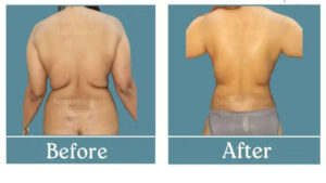 تصویر قبل و بعد از پیکرتراشی با لیپوماتیک ۳۶۰ درجه