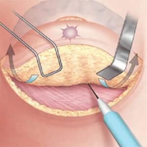 جراحی ماموپلاستی