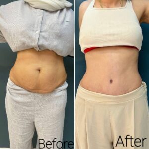 قبل و بعد از پیکرتراشی