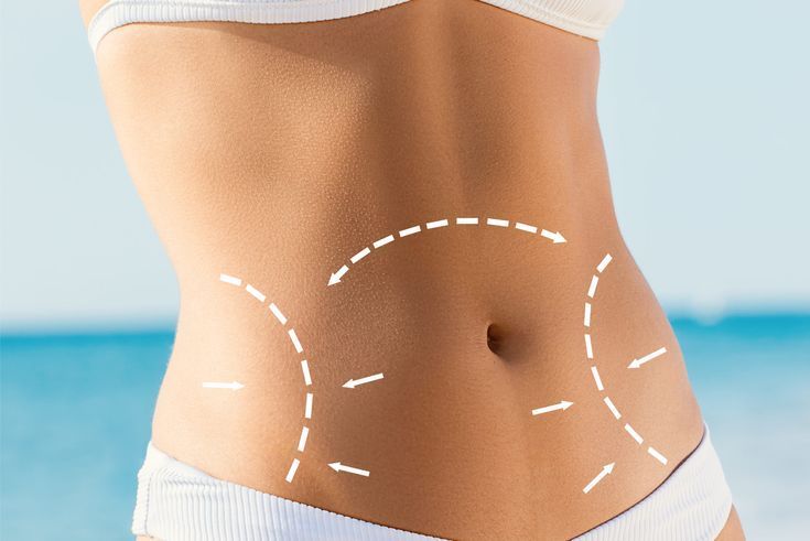 شرایط انجام عمل ابدومینوپلاستی چیست؟