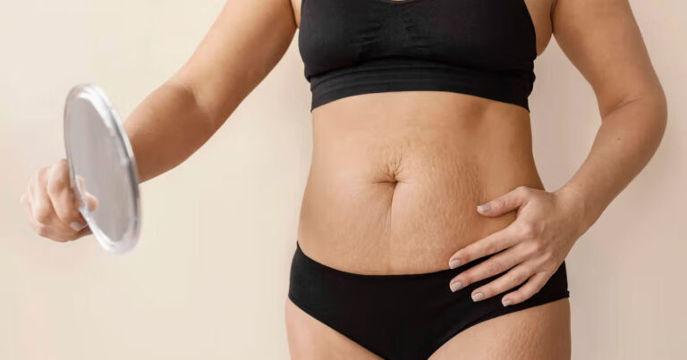 عمل زیبایی شکم یا ابدومینوپلاستی به چه کسانی توصیه نمی شود؟
