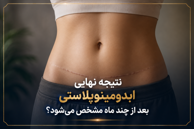 نتیجه نهایی ابدومینوپلاستی؛ طی 3مرحله از ماه سوم تا سال اول